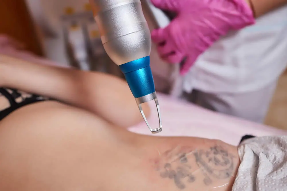 Pico Laser Tattoo Removal in Albany - Levitt Medical Aesthetics