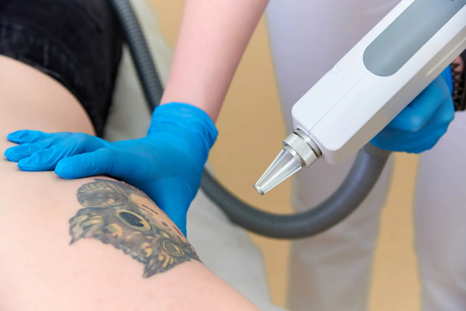 LASER TATTOO REMOVAL - Orland Park, IL Med Spa | FearfullyWonderfullyMade
